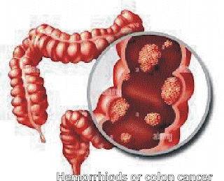 Hemorrhoids symptoms , Colon cancer symptoms , Hemorrhoids vs colon cancer , Understanding hemorrhoids , Signs of hemorrhoids   , Early symptoms of colon cancer , Hemorrhoids diagnosis , Colon cancer diagnosis , Hemorrhoids or cancer , Colon cancer warning signs , Rectal bleeding causes  , Blood in stool symptoms , Painful bowel movements , Persistent abdominal pain   , Swelling near anus  , Hemorrhoids itching symptoms , Colon cancer fatigue , Unexplained weight loss signs , Changes in stool appearance , Chronic constipation